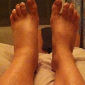 During my pregnancy, my left foot and calf area were particularly swollen
